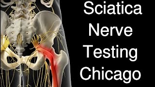 Sciatica Nerve Test Chicago [upl. by Ronny]