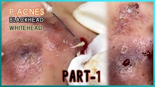 Big Cystic Acne Blackheads Extraction Blackheads amp Milia Whiteheads Removal Pimple Popping [upl. by Maurits178]