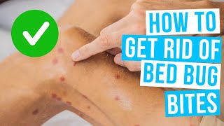 How to GET RID OF BED BUG BITES overnight [upl. by Waers]