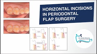 BASIC INCISIONS HORIZONTAL INCISIONS IN PERIODONTAL FLAP SURGERY DR ANKITA KOTECHA [upl. by Nerak113]