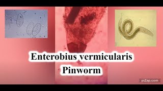 Enterobius vermicularis  Pinworm  Parasitology  pathCast [upl. by Lada]