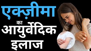 ECZEMA  Causes Symptoms Types Home Remedies amp Ayurvedic Treatment [upl. by Aicia910]