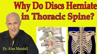 Important Facts Why Discs Herniate in Thoracic Spine Mid back  Dr Mandell [upl. by Fred572]