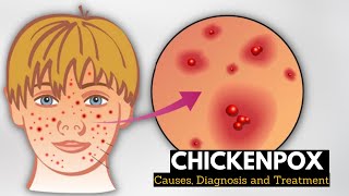 Chickenpox Causes Signs and Symptoms Diagnosis and Treatment [upl. by Rosemare]