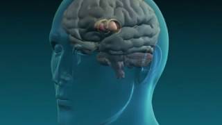 What is the Cause of Athetosis Animation  Basal Ganglia Injury Video [upl. by Moria809]