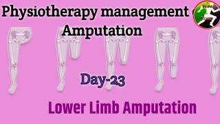 Day 23  physiotherapy management of Amputation Amputation management [upl. by Jessey547]