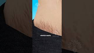 Why Do Stretch Marks Really Happen 😱 shorts viralvideo  Creativelearning3d [upl. by Sutherland290]