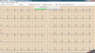 ECG PC EOLYS et WEDA [upl. by Enrico]