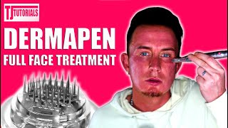 How To Dermapen Microneedling Full Face Treatment 2  Micro Needling 101 [upl. by Leiva963]