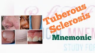 Tuberous Sclerosis Mnemonic [upl. by Waylen]