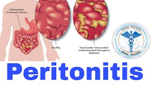 Peritonitis  Nursing Lecture [upl. by Hadik]