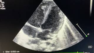 Partial AV septal Defect with Ostium Secundum ASD [upl. by Nodnnarb]