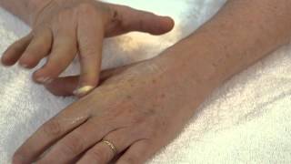 How to Massage a Scar  LB Hand Therapy [upl. by Lienaj]