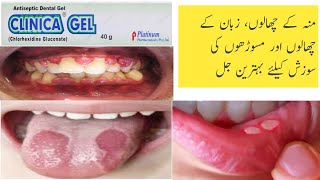 Clinica gel uses and side effects  Chlorhexidine oral gel uses  treatment of mouth ulcers [upl. by Giule208]