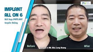 THE BEST DENTAL IMPLANT IN VIETNAMJW KOREA HOSPITAL [upl. by Holli299]