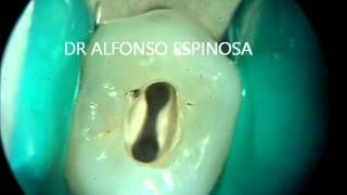 ENDODONCIA CON MICROSCOPIO [upl. by Bray]