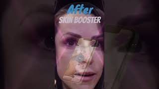 Before amp After Skin Booster glowing profhilo [upl. by Einahpts]