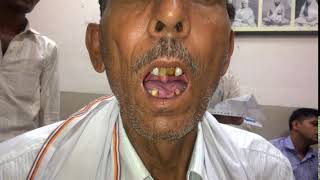 BULBAR PALSY PATIENT WITH TONGUE FASICULATIONS [upl. by Norre]