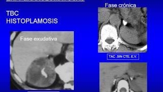 incidentaloma adrenal [upl. by Kucik]