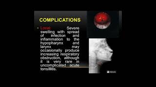 Tonsillitis Definition of tonsillitis  Causes of tonsillitis Symptoms of tonsillitis✨ [upl. by Netsirc]