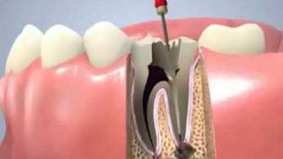 YouTube Traitement de canal traitement endodontique [upl. by Adnwahsat537]