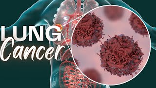 What You Need To Know About Lung Cancer [upl. by Urion]