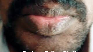 Unique treatment for Vitiligo Safed Daag Treatment in  Bangalore wwwvitiligoskincolourcom [upl. by Dustan]