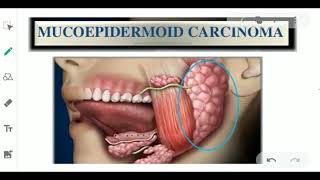 MUCOEPIDERMOID CARCINOMA  ORAL PATHOLOGY  SALIVARY GLAND TUMOR [upl. by Johnette]