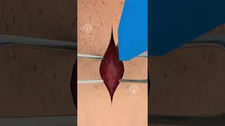 How a Tracheotomy Tube Can Save Lives Hindi shorts viralvideo  Creativelearning3d [upl. by Ahcsas368]