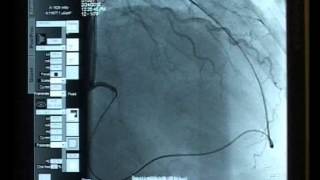 Case 02 Antegrade and Retrograde approach Bilateral Sheathless Radial access [upl. by Helyn]