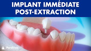 Implant dentaire immédiate postextraction dentaire © [upl. by Amled]