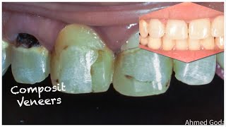 Composite veneers [upl. by Asilenna]