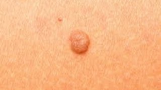 How to Remove Skin Tags at Home DermTVcom Epi 511 [upl. by Justen]