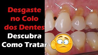 Abfração Dentária  Descubra o Que Causa e qual o Tratamento Para o Desgaste no Colo dos Dentes [upl. by Henke]