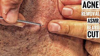 ASMR BEARD SHAVE And Subcutaneous acne removal • Barber Massage • Sleep Asmr [upl. by Deckert]