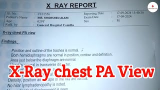 Xray chest PA View Test Review  Investigation  Bangla health tips  Medi Health Point [upl. by Wilcox]