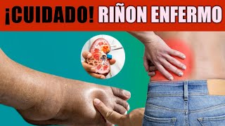 😮Síntomas de PROBLEMAS RENALES para PREVENIR Daños GRAVES [upl. by Tur549]