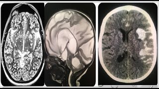 3neuroradiology spotters 15 cases in 15 minutes frcr radiopedia boardexamsmrictxrayanatomy [upl. by Winona]