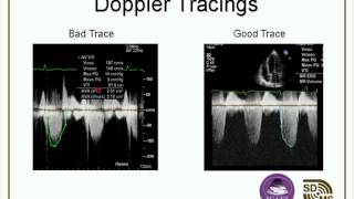 Optimizing Your Echo Images amp Doppler Evaluations webcast [upl. by Hakym705]