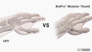 BioPro Modular Thumb Joint Replacement vs Traditional Surgery for Basal Thumb Arthritis [upl. by Folly]