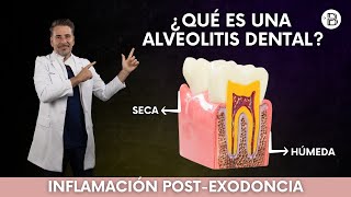 ALVEOLITIS dental Causas y tratamiento🦷 [upl. by Anu727]