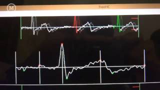 Electrocardiogram using Arduino and ECGEKG shield [upl. by Nnawtna277]