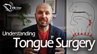 What you Need to Know about Tongue Surgery for Sleep Apnoea [upl. by Hirsch]