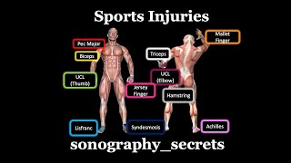 Ultrasound of Sports injuries by sonographysecrets [upl. by Alemahs]