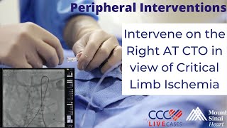 Intervene on the Right AT CTO in view of Critical Limb Ischemia  Peripheral Live March 2015 [upl. by Nehepts]