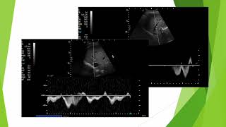 Doppler des veines sushépatiques flux monophasique de cirrhose [upl. by Adnohsor]