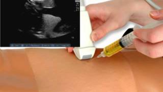 Thoracostomy amp Ultrasound Thoracentesis Model [upl. by Burnside]