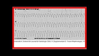 Ventrikuläre Tachykardie [upl. by Haroppizt]