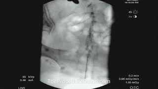 Fluoroscopic Caudal Epidural Contrast Spread [upl. by Baudoin]