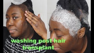 How to wash Scabs and Suture line After a Hair Transplant [upl. by Adias]